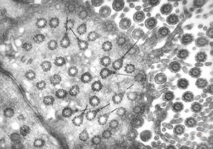 F,5y. | immotile cilia syndrome - trachea